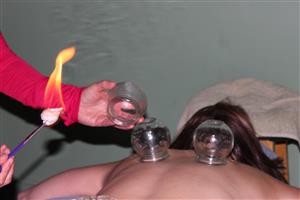 cupping1